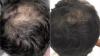 Best Hair Specialist Abu Dhabi | PRP treatment in Abu Dhabi