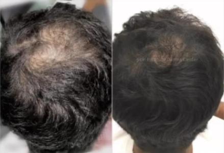 Best Hair Specialist Abu Dhabi | PRP treatment in Abu Dhabi