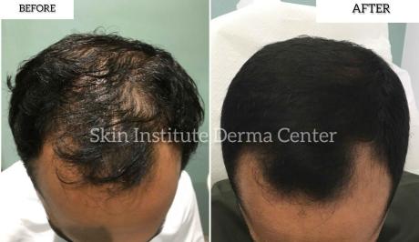 Best PRP Hair Treatment In Abu Dhabi | Skin Clinic