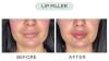 Expert Lip Fillers at Abu Dhabi's Premier Dermatology Centre