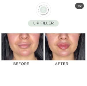 Expert Lip Fillers at Abu Dhabi's Premier Dermatology Centre