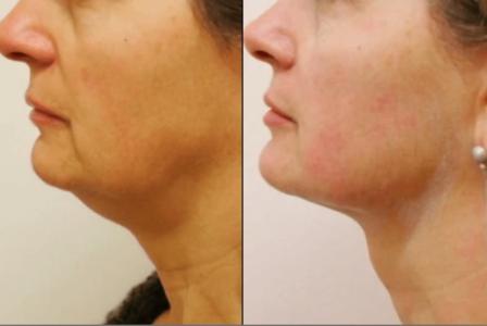 Face lifting treatment near me | Skin Institute Clinic Abu Dhabi