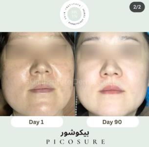 Pico Laser Treatment In Abu Dhabi Skin Clinic