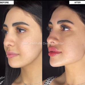 Best lip filler injections in Abu Dhabi | Skin Institute Clinic