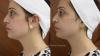 Profhilo Treatment Abu Dhabi