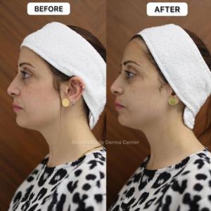 Profhilo Treatment Abu Dhabi