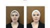 Hydrafacial Treatment In Abu Dhabi | Skin Institute Dermatology Centre