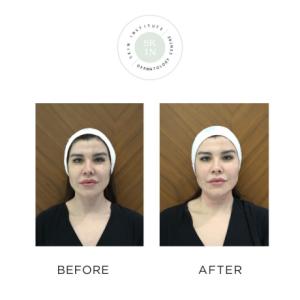 Hydrafacial Treatment In Abu Dhabi | Skin Institute Dermatology Centre